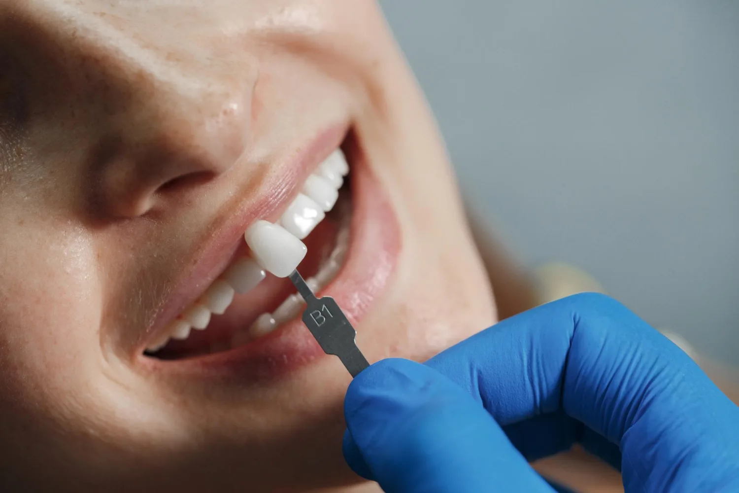 Coronas de porcelana en CDMX: la solución estética y funcional para tu sonrisa