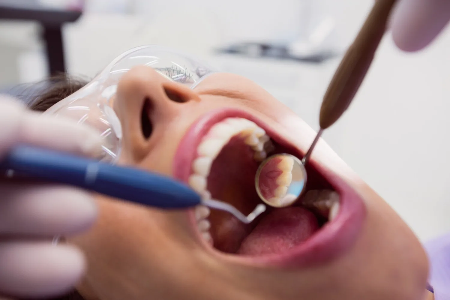 Curetaje cerrado en CDMX: Tratamiento avanzado para la salud periodontal